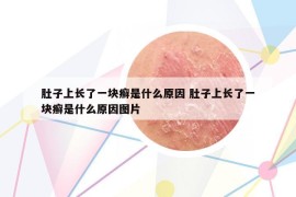 肚子上长了一块癣是什么原因 肚子上长了一块癣是什么原因图片