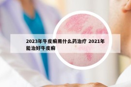 2023年牛皮癣用什么药治疗 2021年能治好牛皮癣