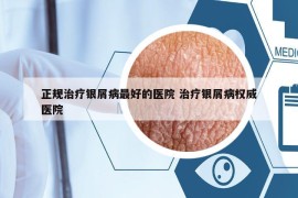 正规治疗银屑病最好的医院 治疗银屑病权威医院