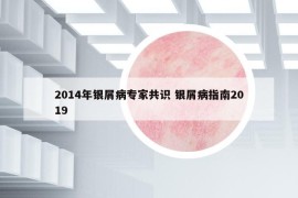 2014年银屑病专家共识 银屑病指南2019