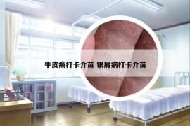 牛皮癣打卡介苗 银屑病打卡介苗