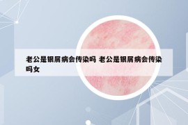 老公是银屑病会传染吗 老公是银屑病会传染吗女