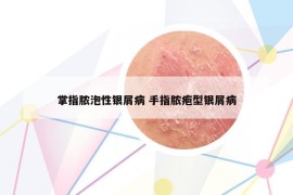 掌指脓泡性银屑病 手指脓疱型银屑病
