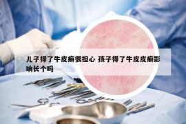 儿子得了牛皮癣很担心 孩子得了牛皮皮癣影响长个吗