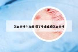 怎么治疗牛皮癣 得了牛皮皮癣怎么治疗