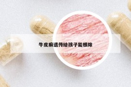 牛皮癣遗传给孩子能根除