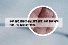 牛皮癣吃转移因子口服溶液液 牛皮肤癣吃转移因子口服溶液好用吗