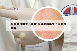银屑病传染怎么治疗 银屑病传染怎么治疗效果好