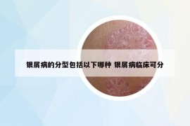 银屑病的分型包括以下哪种 银屑病临床可分