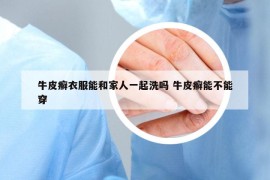 牛皮癣衣服能和家人一起洗吗 牛皮癣能不能穿