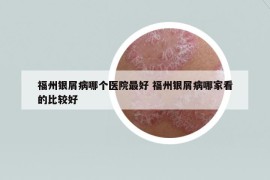 福州银屑病哪个医院最好 福州银屑病哪家看的比较好