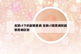 皮肤ct下的副银屑病 皮肤ct银屑病和副银屑病区别