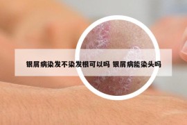 银屑病染发不染发根可以吗 银屑病能染头吗