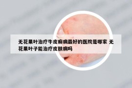 无花果叶治疗牛皮癣病最好的医院是哪家 无花果叶子能治疗皮肤病吗