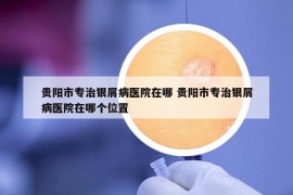 贵阳市专治银屑病医院在哪 贵阳市专治银屑病医院在哪个位置