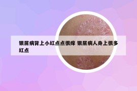 银屑病背上小红点点很痒 银屑病人身上很多红点