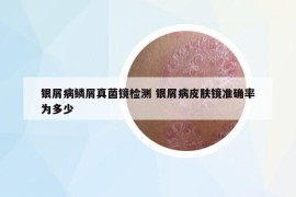 银屑病鳞屑真菌镜检测 银屑病皮肤镜准确率为多少