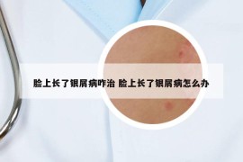 脸上长了银屑病咋治 脸上长了银屑病怎么办