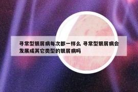 寻常型银屑病每次都一样么 寻常型银屑病会发展成其它类型的银屑病吗