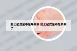 脸上起皮是不是牛皮癣 脸上起皮是不是长癣了