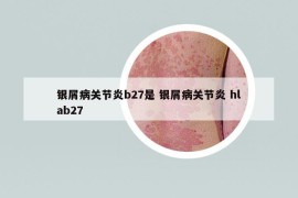 银屑病关节炎b27是 银屑病关节炎 hlab27