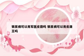 银屑病可以用军医皮霸吗 银屑病可以用皮康王吗
