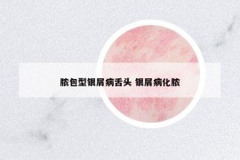 脓包型银屑病舌头 银屑病化脓
