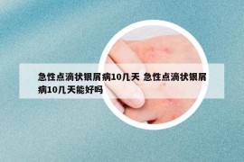 急性点滴状银屑病10几天 急性点滴状银屑病10几天能好吗
