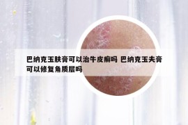 巴纳克玉肤膏可以治牛皮癣吗 巴纳克玉夫膏可以修复角质层吗