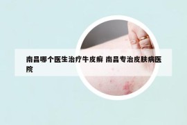 南昌哪个医生治疗牛皮癣 南昌专治皮肤病医院