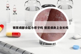 银屑病都会起小疹子吗 银屑病身上会长吗