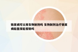 销屑病可以用生物制剂吗 生物制剂治疗银屑病能医保能报销吗