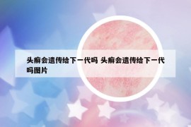 头癣会遗传给下一代吗 头癣会遗传给下一代吗图片