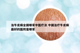 治牛皮癣全国哪家中医疗法 中国治疗牛皮癣最好的医院是哪家