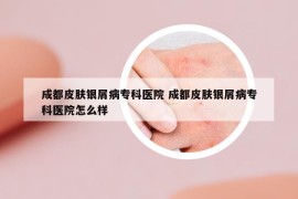 成都皮肤银屑病专科医院 成都皮肤银屑病专科医院怎么样