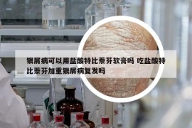 银屑病可以用盐酸特比萘芬软膏吗 吃盐酸特比萘芬加重银屑病复发吗