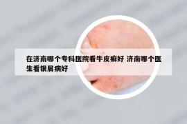 在济南哪个专科医院看牛皮癣好 济南哪个医生看银屑病好
