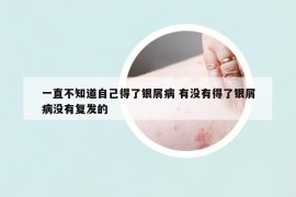 一直不知道自己得了银屑病 有没有得了银屑病没有复发的