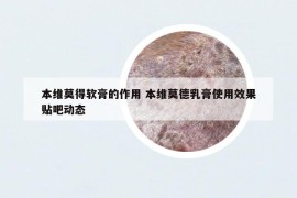 本维莫得软膏的作用 本维莫德乳膏使用效果贴吧动态