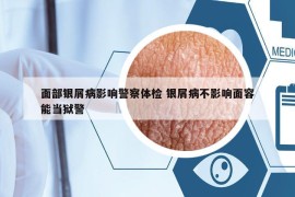 面部银屑病影响警察体检 银屑病不影响面容能当狱警