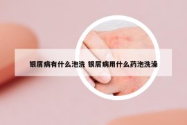 银屑病有什么泡洗 银屑病用什么药泡洗澡