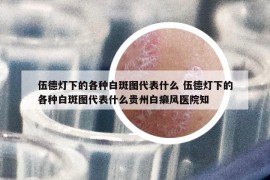 伍德灯下的各种白斑图代表什么 伍德灯下的各种白斑图代表什么贵州白癞风医院知