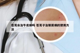 苍耳水治牛皮癣吗 苍耳子治银屑病的使用方法