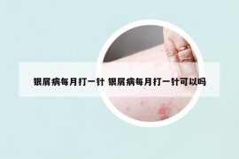 银屑病每月打一针 银屑病每月打一针可以吗