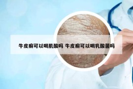 牛皮癣可以喝肌酸吗 牛皮癣可以喝乳酸菌吗