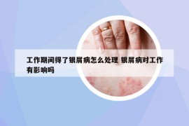 工作期间得了银屑病怎么处理 银屑病对工作有影响吗
