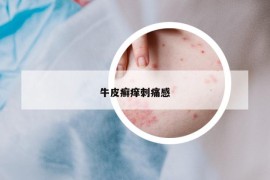 牛皮癣痒刺痛感