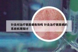 针灸对治疗银屑病有效吗 针灸治疗银屑病的系统机理探讨