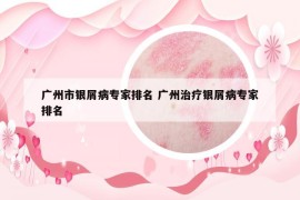 广州市银屑病专家排名 广州治疗银屑病专家排名