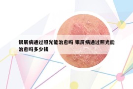 银屑病通过照光能治愈吗 银屑病通过照光能治愈吗多少钱